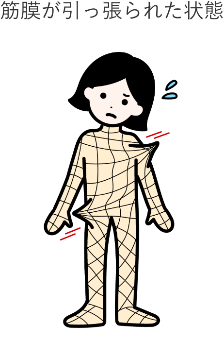 筋膜が引っ張られたイメージのイラスト